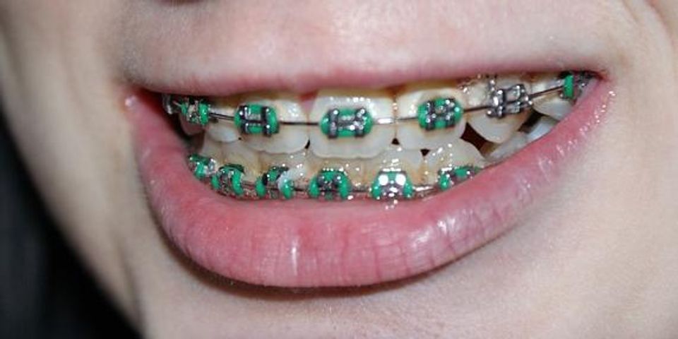 Gap Teeth Is Dental Care Worth The Cost To Fix Them Pediatric