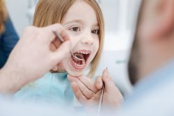 dental sealants for kids