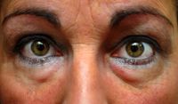 eyelid-surgery-medical-eye-center