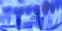 dental-implant-hulse-dental
