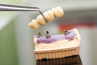dental-implants-baraboo-wi