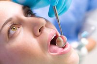 cavities-athens-family-dental