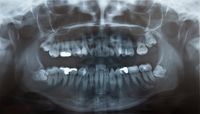 tooth-extraction-Naugatuck-CT