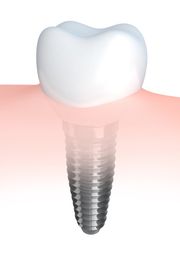 anchorage-dental-implants