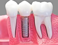 dental-implants-stadler-dental-care