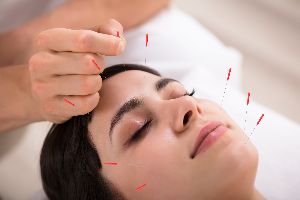 acupuncture