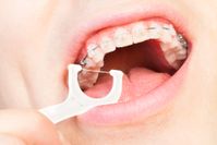 braces-othodontist-teeth-straightening