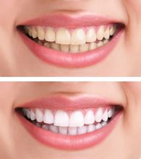 Teeth-Whitening-Enterprise-AL