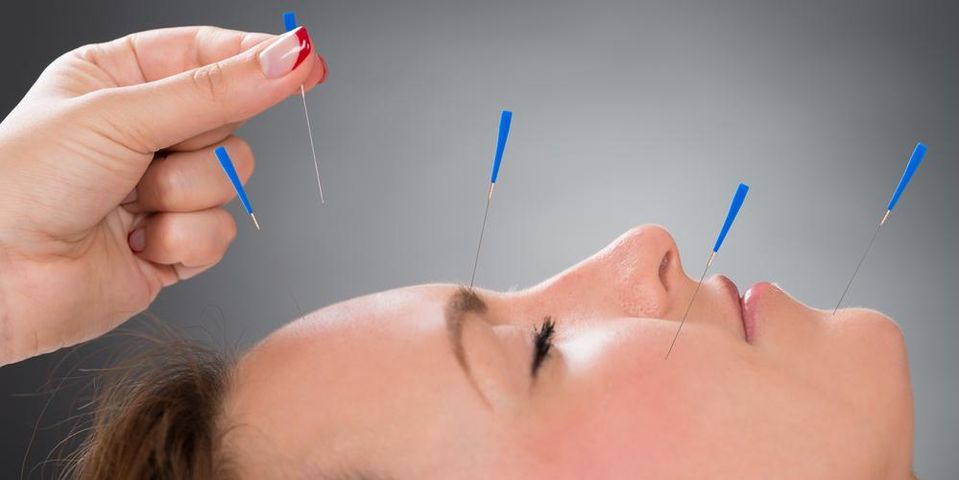 3 Advantages of Acupuncture Treatment - Avicenna Acupuncture & Lymphedema  Clinic