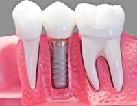 dental-implants-dr-andrew-r-glenn-dds-md-pc
