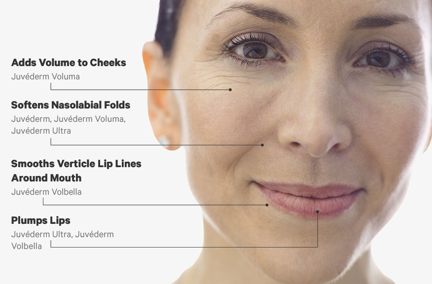 JUVEDERM_Treatment_Area_Infographic