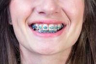braces-delgado-orthodontics