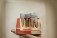 tooth-implants-c-r-sfeir-dds-general-dentistry