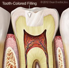 tooth-filling-honolulu