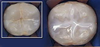 Tooth sealant