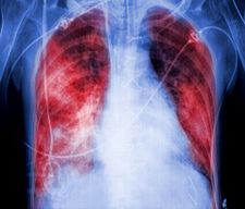 lung screening