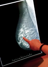 mammogram