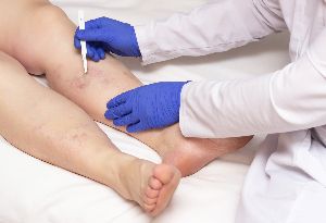 sclerotherapy