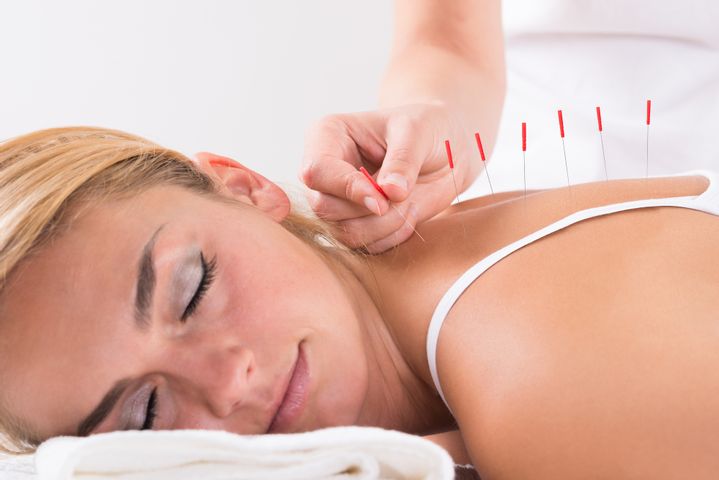 How to prepare for acupuncture