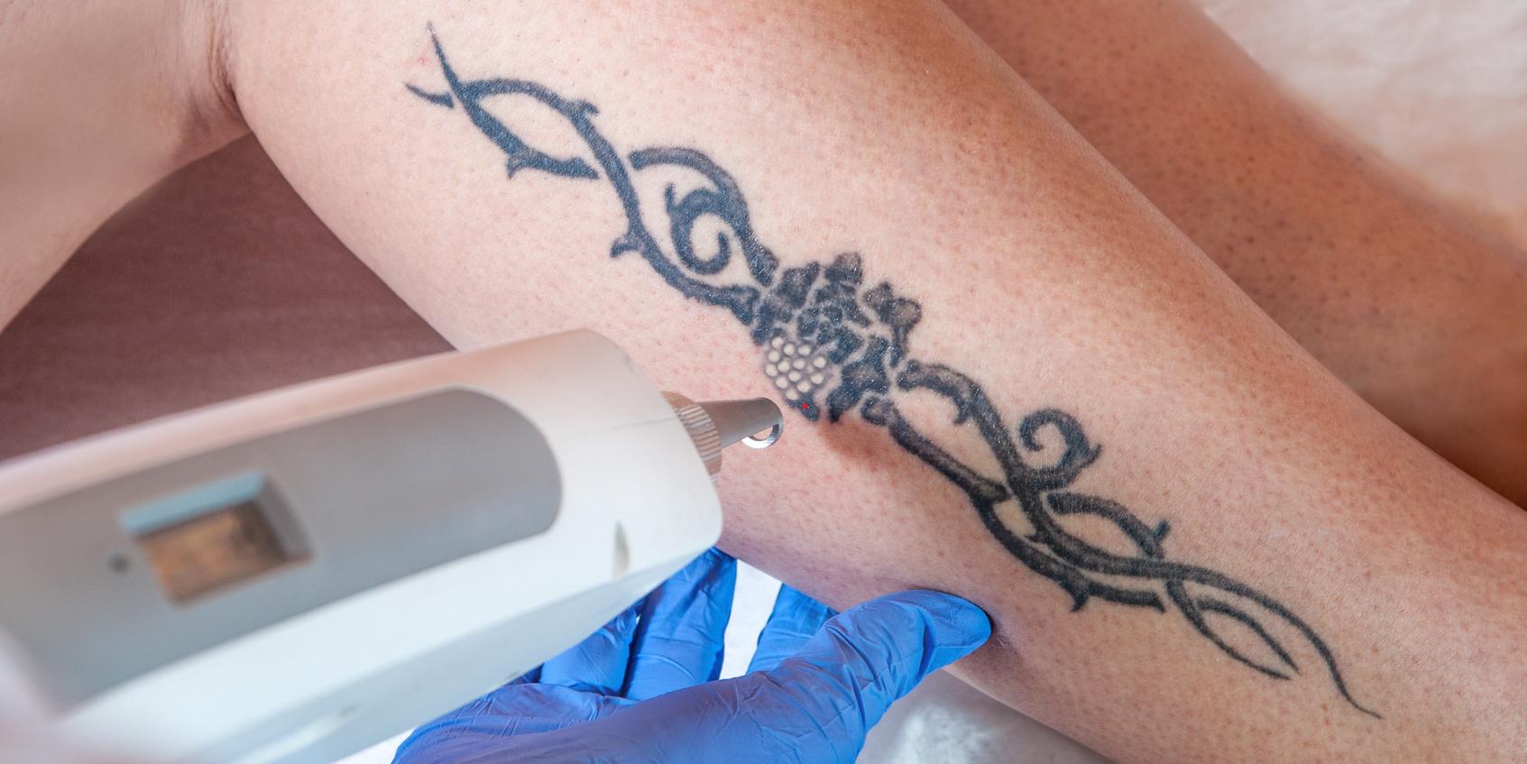 Alexandrite Picosecond Laser for Tattoo Removal | Dr. Cameron Rokhsar