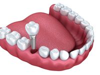 dental-implants-Rochester-NY