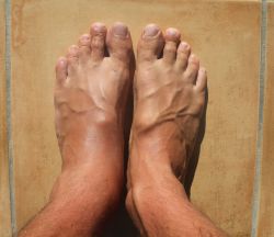 swollen feet Rochester NY