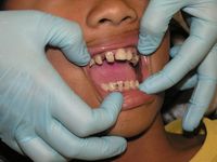 Teeth Cleanings